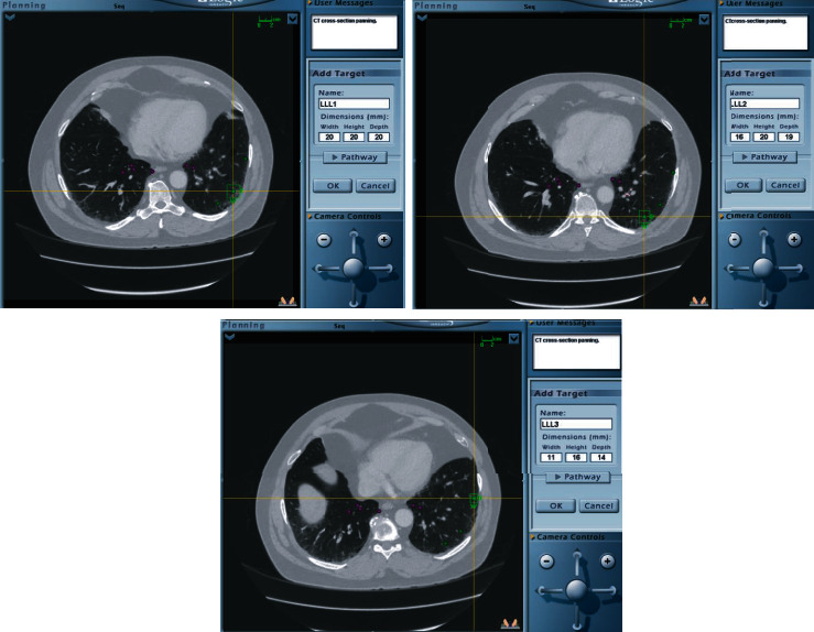 Navigational Bronchoscopy with Cryobiopsy for Diagnosis of ILD.