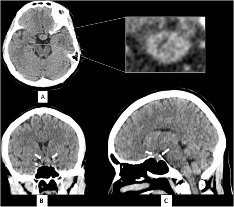 Pituitary apoplexy after COVID-19 vaccination: A case report