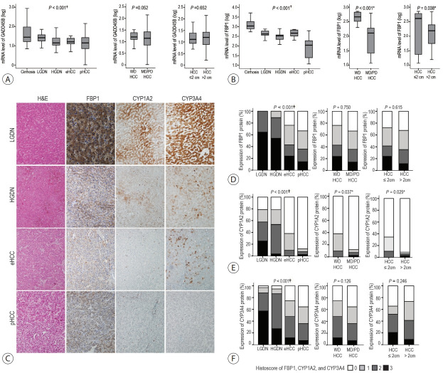 The dual role of transforming growth factor-beta signatures in human B viral multistep hepatocarcinogenesis: early and late responsive genes.