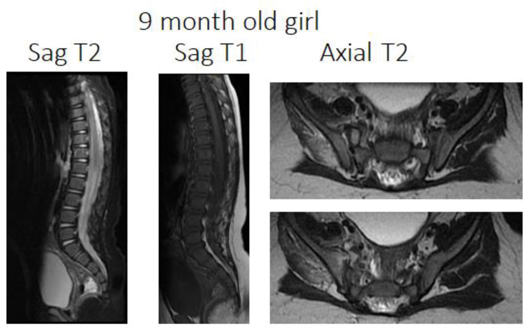 A case report of pyogenic sacroiliitis in a 9-month-old child.