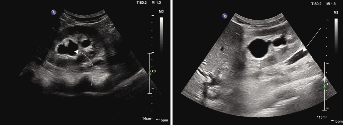 Blind-ending Bifid Ureter - A Case Report of Rare Congenital Anomaly and its Sonographic Appearance.