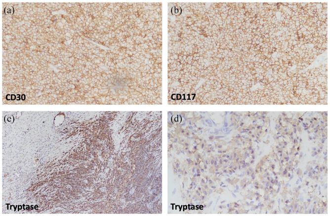 Mast Cell Sarcoma of the Retroperitoneum With Concurrent Systemic Mastocytosis and an Undisclosed Associated Hematologic Neoplasm: A Case Report.