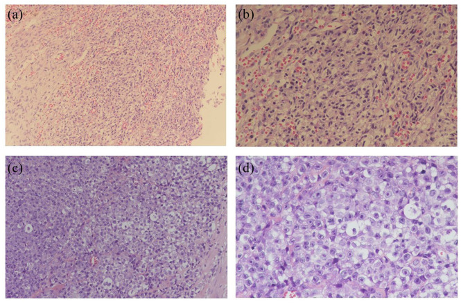 Mast Cell Sarcoma of the Retroperitoneum With Concurrent Systemic Mastocytosis and an Undisclosed Associated Hematologic Neoplasm: A Case Report.