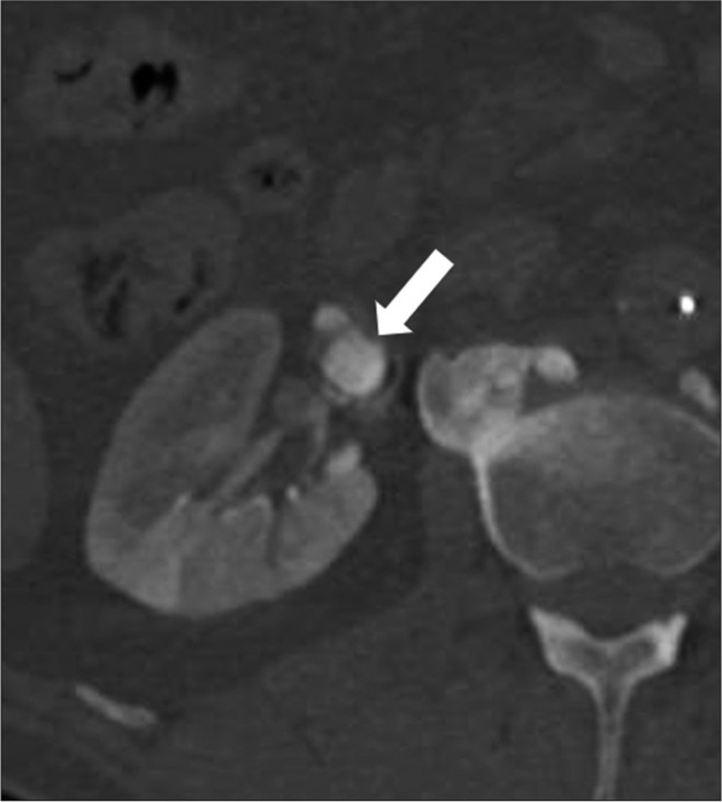Coil embolization of a complex renal artery aneurysm using a new scaffold (Comaneci) device - A case report.