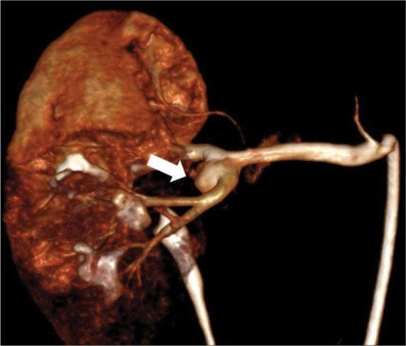 Coil embolization of a complex renal artery aneurysm using a new scaffold (Comaneci) device - A case report.