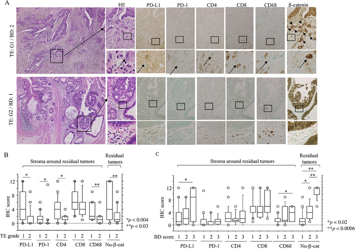 A combination of stromal PD-L1 and tumoral nuclear β-catenin expression as an indicator of colorectal carcinoma progression and resistance to chemoradiotherapy in locally advanced rectal carcinoma.