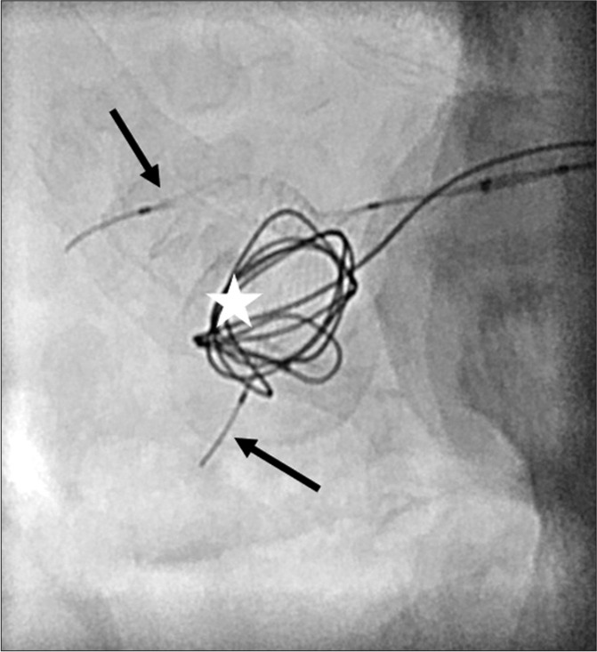 Coil embolization of a complex renal artery aneurysm using a new scaffold (Comaneci) device - A case report.