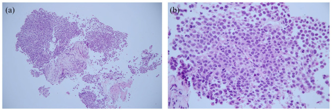 Mast Cell Sarcoma of the Retroperitoneum With Concurrent Systemic Mastocytosis and an Undisclosed Associated Hematologic Neoplasm: A Case Report.