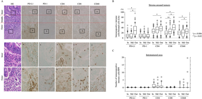 A combination of stromal PD-L1 and tumoral nuclear β-catenin expression as an indicator of colorectal carcinoma progression and resistance to chemoradiotherapy in locally advanced rectal carcinoma.