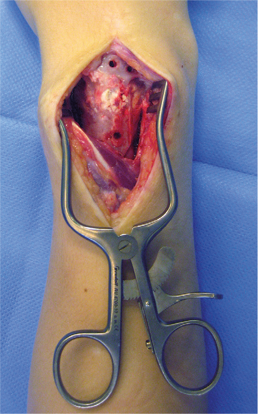 Calcium phosphate bone cement and metaphyseal -corrective osteotomies in the upper extremity: long-term follow-up of 10 children.