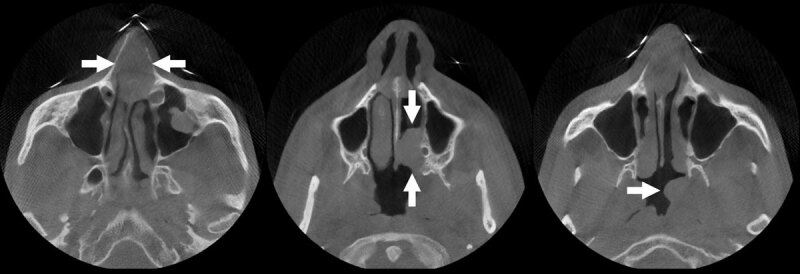 Nasal and Nasopharyngeal Rosai-Dorfman Disease.