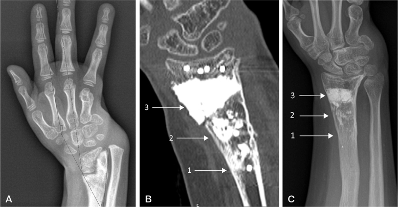 Calcium phosphate bone cement and metaphyseal -corrective osteotomies in the upper extremity: long-term follow-up of 10 children.