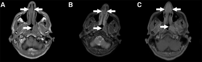 Nasal and Nasopharyngeal Rosai-Dorfman Disease.