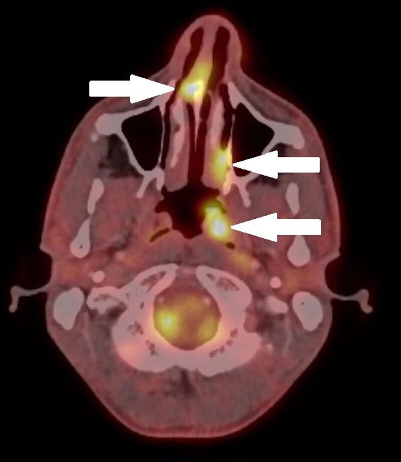 Nasal and Nasopharyngeal Rosai-Dorfman Disease.