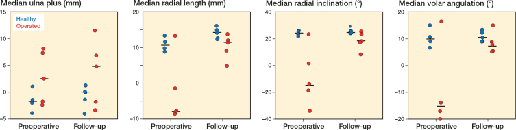 Calcium phosphate bone cement and metaphyseal -corrective osteotomies in the upper extremity: long-term follow-up of 10 children.