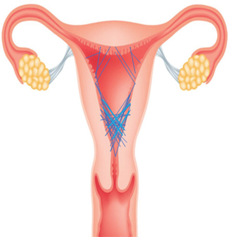 Comparison of the localization of intrauterine adhesions in pregnant and infertile women.