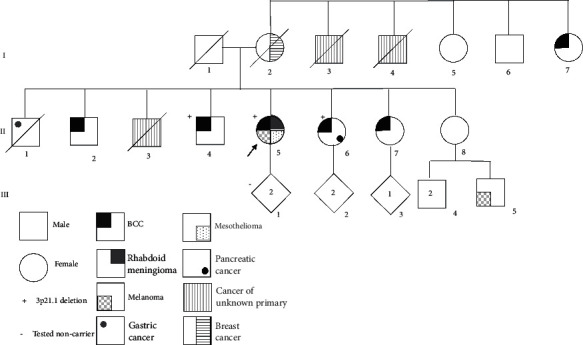 BAP1 Tumour Predisposition Syndrome Due to Whole BAP1 Gene Deletion.