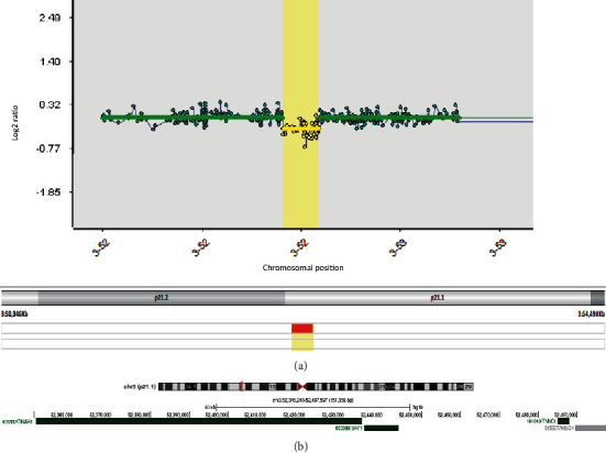 BAP1 Tumour Predisposition Syndrome Due to Whole BAP1 Gene Deletion.