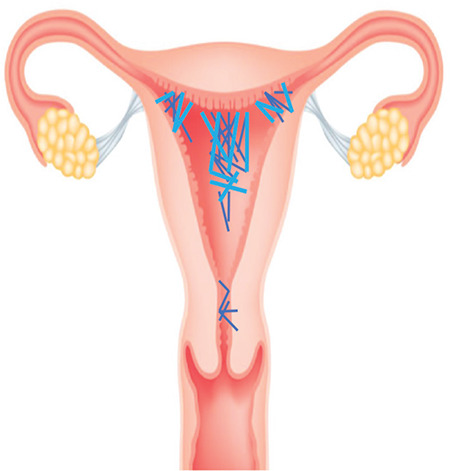 Comparison of the localization of intrauterine adhesions in pregnant and infertile women.