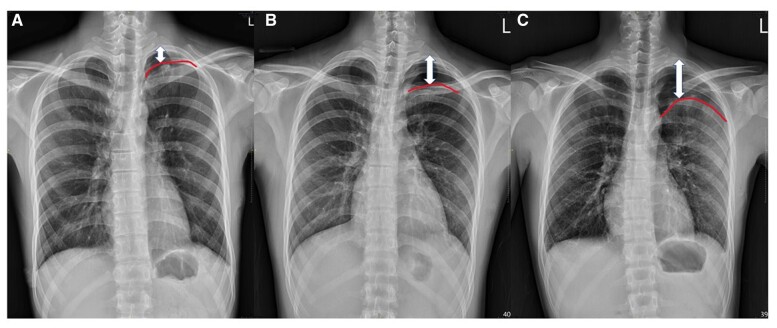 Drainless thoracoscopic surgery should be avoided in primary spontaneous pneumothorax with pleural adhesion.