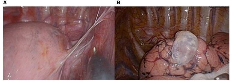 Drainless thoracoscopic surgery should be avoided in primary spontaneous pneumothorax with pleural adhesion.