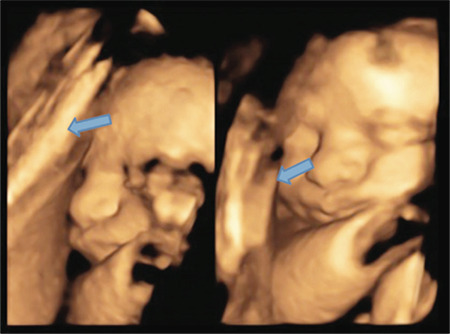 Comparison of the localization of intrauterine adhesions in pregnant and infertile women.