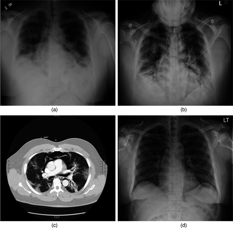 A Case of Spontaneous Pneumomediastinum in Covid-19 Pneumonia.