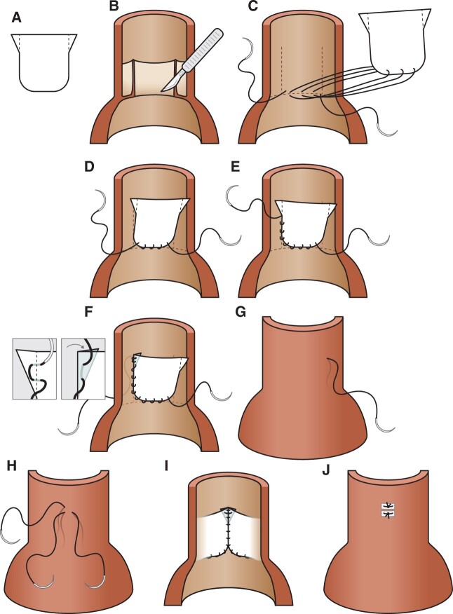 Trileaflet semilunar valve reconstruction: pulsatile in vitro evaluation.