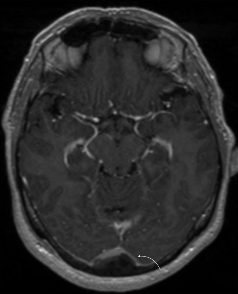 A Rare Case of Extrinsic Stenosis of Dural Sinus.