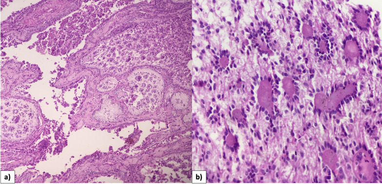 Ovarian sex cord tumor with annular tubules: case report and review of the literature