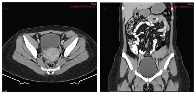 Ovarian sex cord tumor with annular tubules: case report and review of the literature