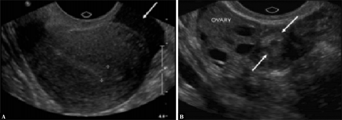 Sonographic Findings of a Gynecological Cause of Acute Pelvic Pain - A Systematic Review.