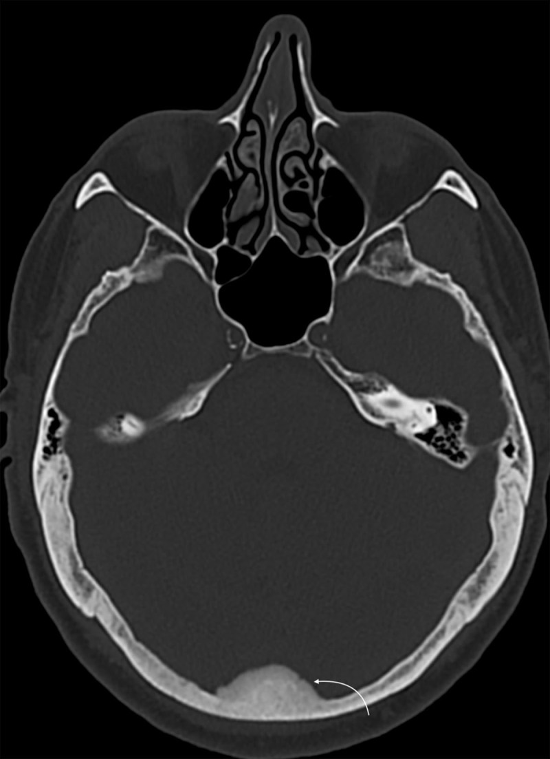 A Rare Case of Extrinsic Stenosis of Dural Sinus.