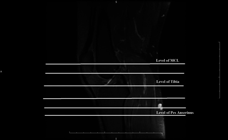 Investigating the magnetic resonance imaging cross-section area that best correlates with intraoperative hamstring autograft size.