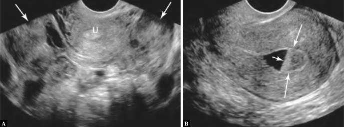 Sonographic Findings of a Gynecological Cause of Acute Pelvic Pain - A Systematic Review.