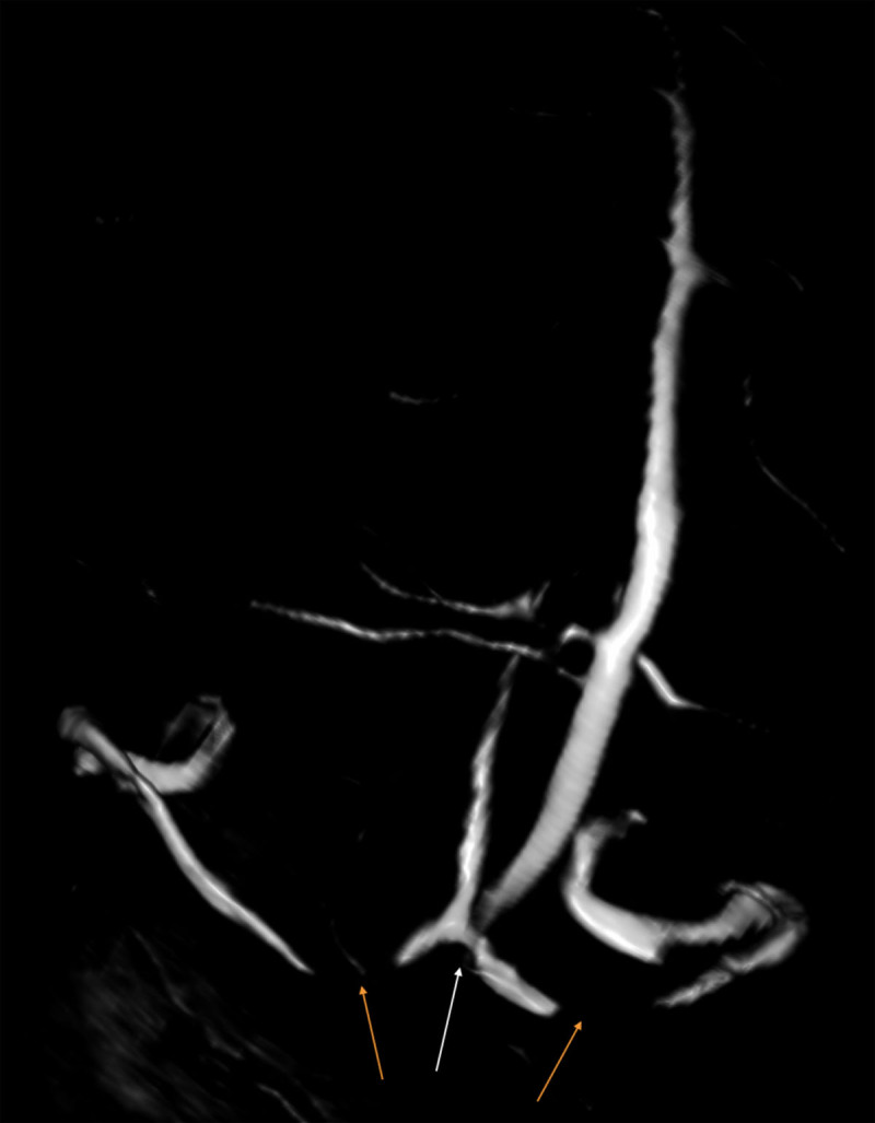 A Rare Case of Extrinsic Stenosis of Dural Sinus.