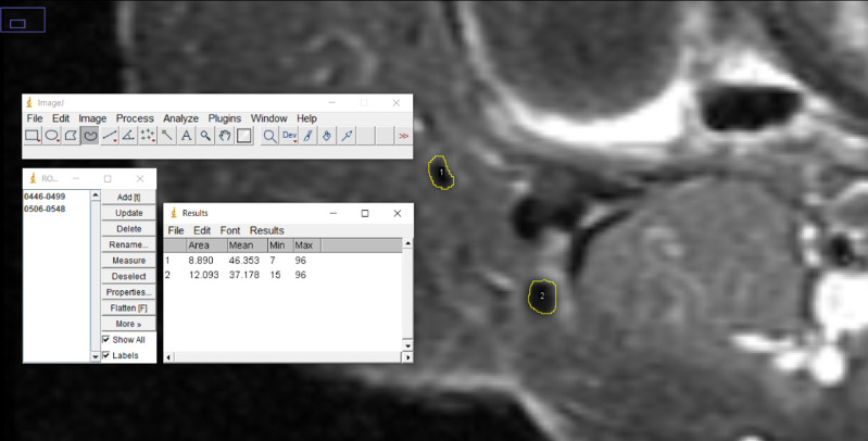 Investigating the magnetic resonance imaging cross-section area that best correlates with intraoperative hamstring autograft size.