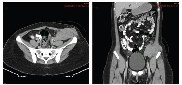 Ovarian sex cord tumor with annular tubules: case report and review of the literature