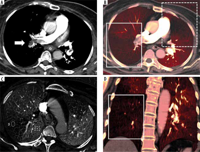 Can clot size and stenotic degree predict perfusion defects on conventional computed tomographic pulmonary angiography in diagnoses of pulmonary embolism?