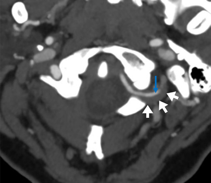 Catastrophic Fibromuscular Dysplasia Presenting with Concomitant Bilateral Renal Infarction, Vertebral Artery Dissection, and Mesenteric Ischaemia.