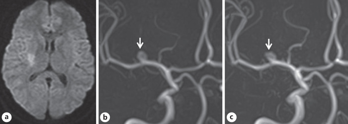 Rapid Change in Shape of Unruptured Intracranial Aneurysm with Acute Perforating Infarction.