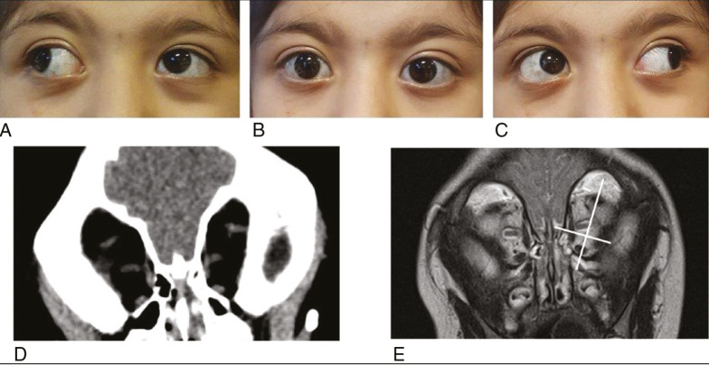 Ophthalmological Care of Patients With Craniofacial Disorders.