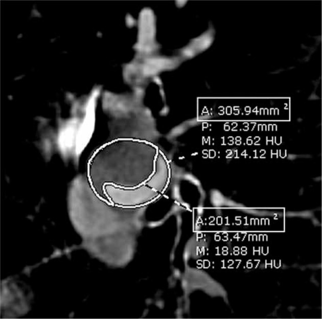 Can clot size and stenotic degree predict perfusion defects on conventional computed tomographic pulmonary angiography in diagnoses of pulmonary embolism?