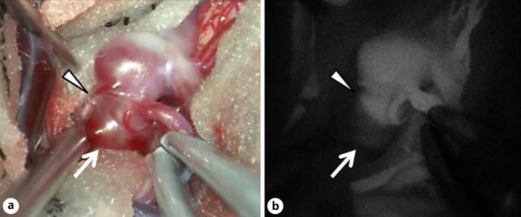 Rapid Change in Shape of Unruptured Intracranial Aneurysm with Acute Perforating Infarction.