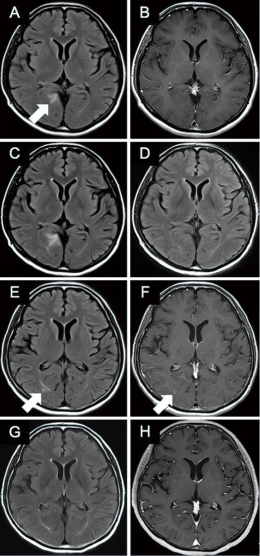 A Case of Relapsed Primary Central Nervous System Lymphoma Treated with CD19-directed Chimeric Antigen Receptor T Cell Therapy.