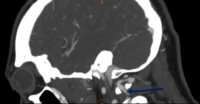 Catastrophic Fibromuscular Dysplasia Presenting with Concomitant Bilateral Renal Infarction, Vertebral Artery Dissection, and Mesenteric Ischaemia.