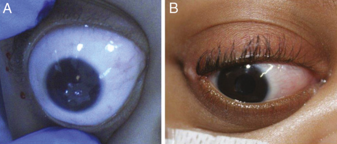 Ophthalmological Care of Patients With Craniofacial Disorders.