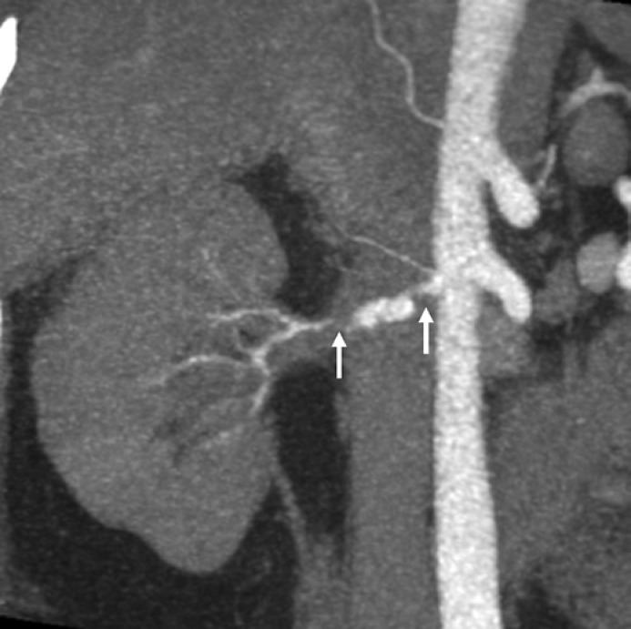 Catastrophic Fibromuscular Dysplasia Presenting with Concomitant Bilateral Renal Infarction, Vertebral Artery Dissection, and Mesenteric Ischaemia.