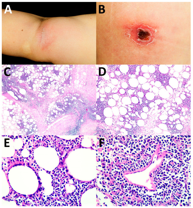 Cutaneous Involvement of Extranodal NK/T Cell Lymphoma, Nasal Type, a Clinical and Histopathological Mimicker of Various Skin Diseases.