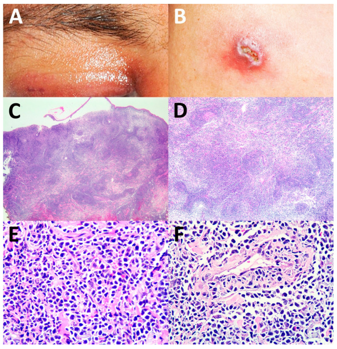 Cutaneous Involvement of Extranodal NK/T Cell Lymphoma, Nasal Type, a Clinical and Histopathological Mimicker of Various Skin Diseases.